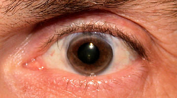 Augendiagnose Irisdiagnose